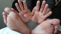 Кір на Закарпатті відступає: кількість нових випадків захворювання зменшується