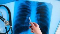 На Закарпатті діагностуватимуть туберкульоз у 1000 разів швидше