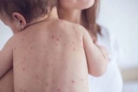 На 12% відсотків знизилась кількість захворілих на кір у Закарпатській області (ВІДЕО)