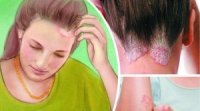 На псоріаз хворіють 1,5 мільйона українців. Недуга невиліковна, але її можна успішно контролювати